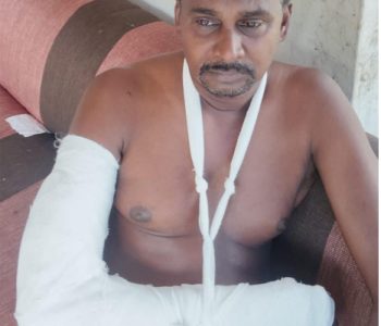 കുറുനരി ആക്രമണത്തില്‍ പരിക്കേറ്റ ഉണ്ണികൃഷ്ണന്‍